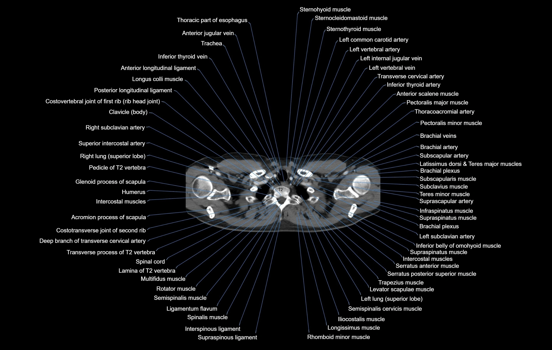 CT chest (thorax) labelled axial cross sectional anatomy radiology image-00008.webp